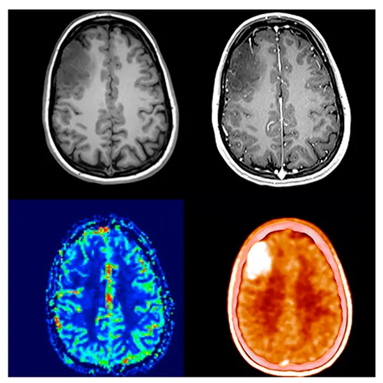 What Are The Indications For Brain PET Scan?